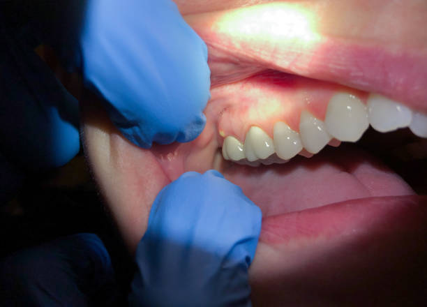 Best Urgent Tooth Repair  in Ross, CA