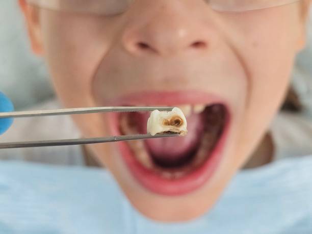 Best Chipped Tooth Repair Near Me  in Ross, CA